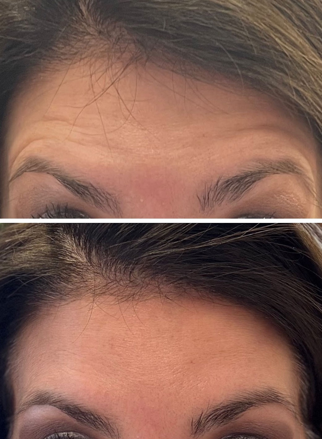 The image shows a close-up comparison of a person s face before and after a cosmetic procedure, likely a brow lift or similar treatment, with visible differences in the eyebrow area.
