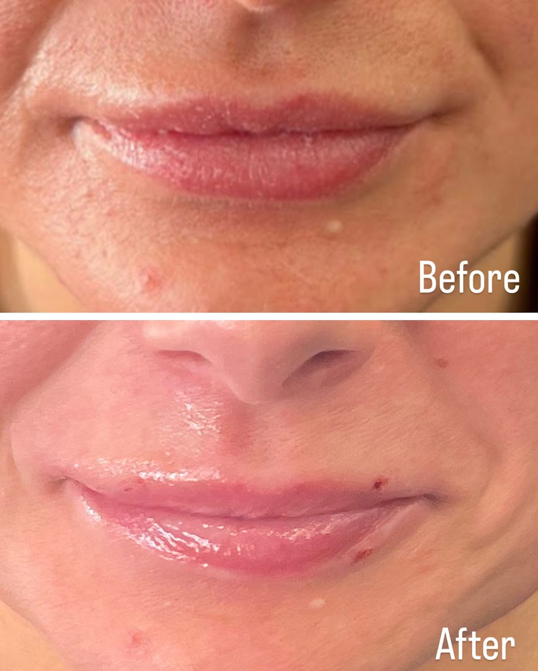 The image shows a before-and-after comparison of a person s lips after cosmetic treatment, with the before picture showing natural lip appearance and the after picture showing enhanced fullness.